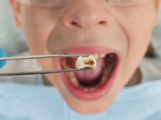 Best Emergency Treatment for Dental Infections or Abscesses in Frazeysburg, OH